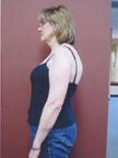 March 2005 Scoliosis Progression