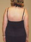 April 2005 Scoliosis Progression