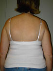 April 2006 Scoliosis Progression