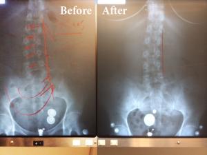 X-RAY before and after 41 YOA Female after 8 ATM2 treatments